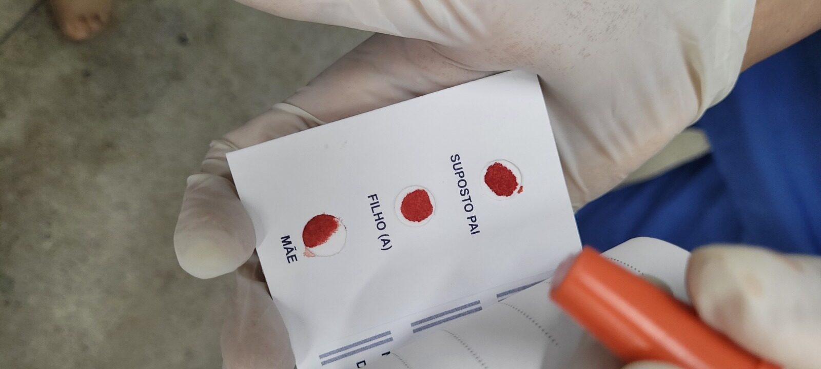 Imagem mostram material biológico recolhido durante teste de paternidade.